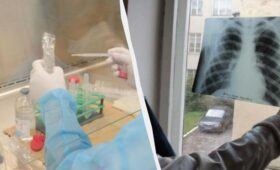 Пробы Манту в Украине больше не будет: чем заменят